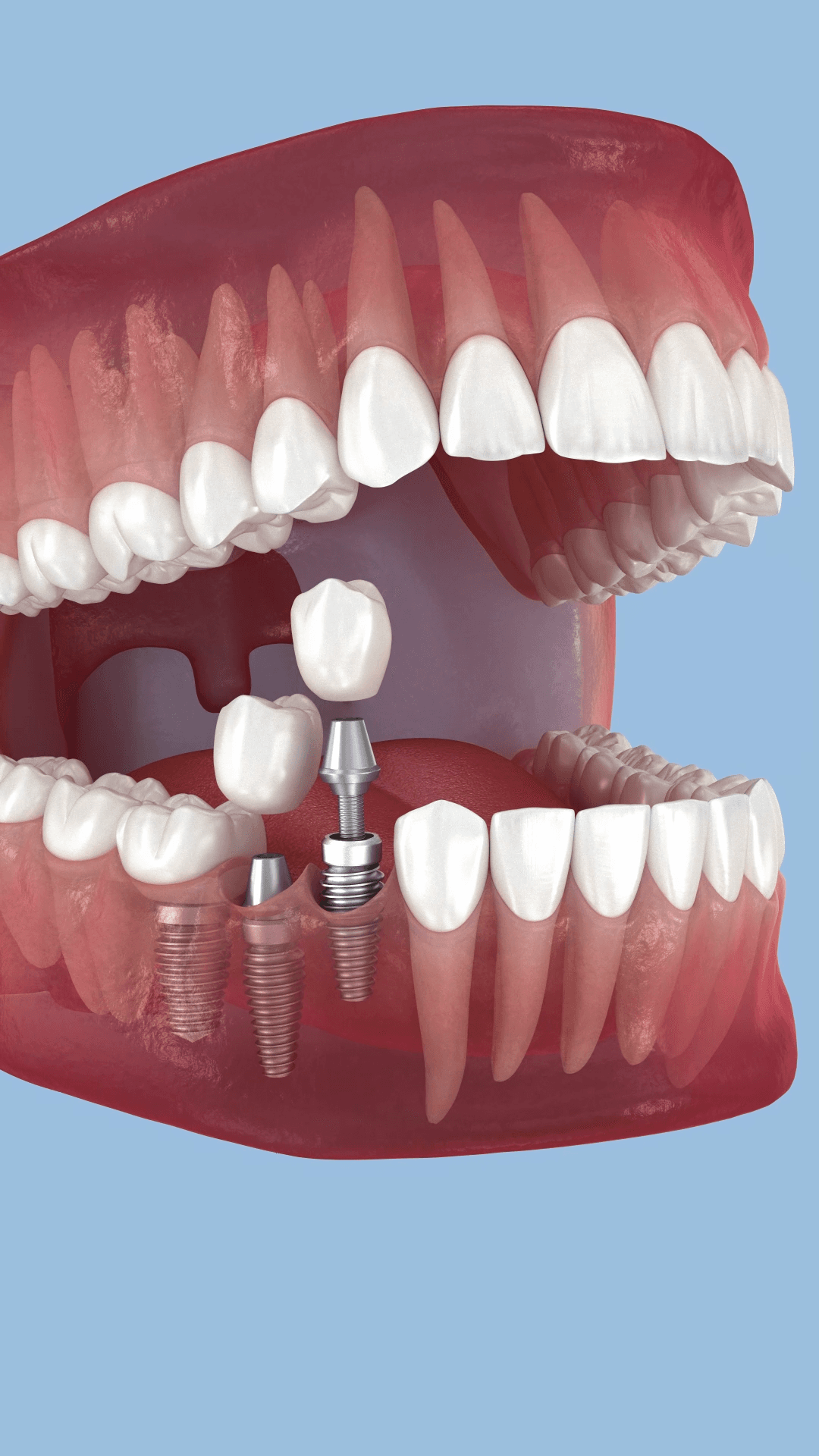 Ilustración del proceso paso a paso para implantes dentales