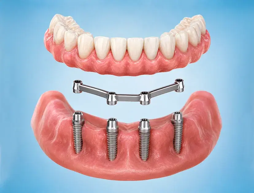 Prótesis removible levantada sobre la barra que la sujeta a cuatro implantes del maxilar inferior