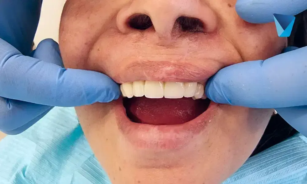 Aprende cómo arreglar una sonrisa gingival pronunciada con tratamientos dentales disponibles en Chile. Descubre opciones para reducir la encía visible y mejorar tu estética dental. Corregir Sonrisa Gingival: Tratamientos Odontológicos en Chile