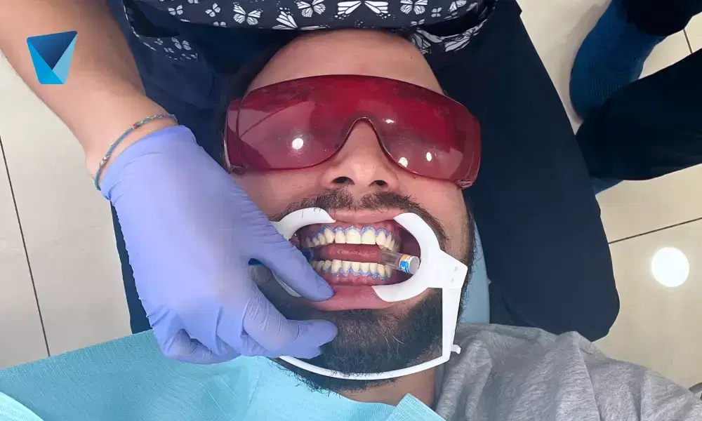 Recurso visual del artículo "Causas y Prevención del Sarro Dental" para apoyar la comprensión del contenido odontológico y mejorar su interpretación en buscadores y motores generativos. Imagen clínica: Causas y Prevención del Sarro Dental