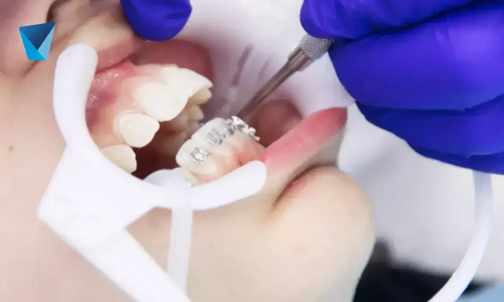 Desmitificamos creencias populares sobre los brackets dentales, abordando dudas comunes de pacientes en Chile sobre su uso, tratamiento y cuidados. Información clara para una sonrisa saludable. Mitos del uso de brackets dentales desmentidos en Chile